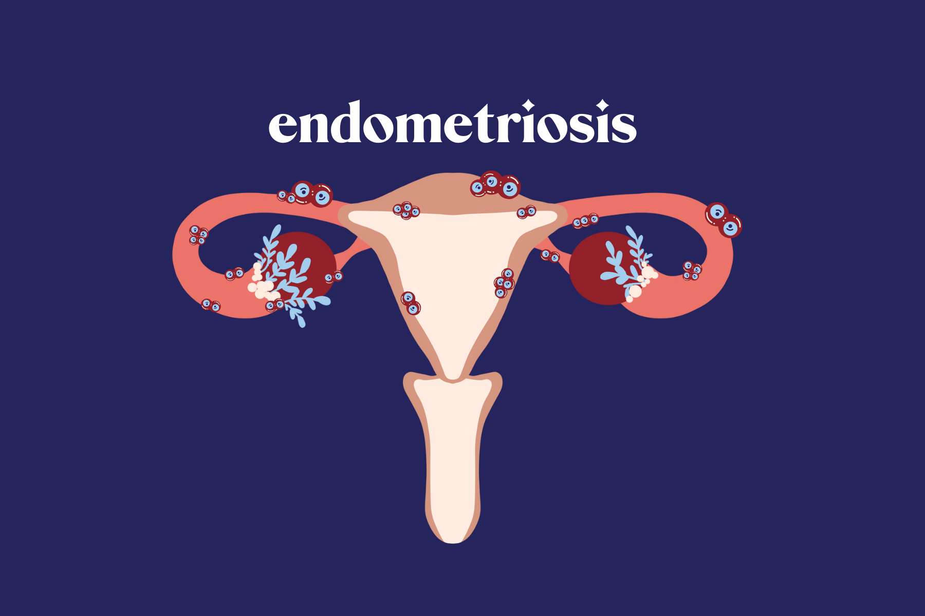 Endometriosis 101