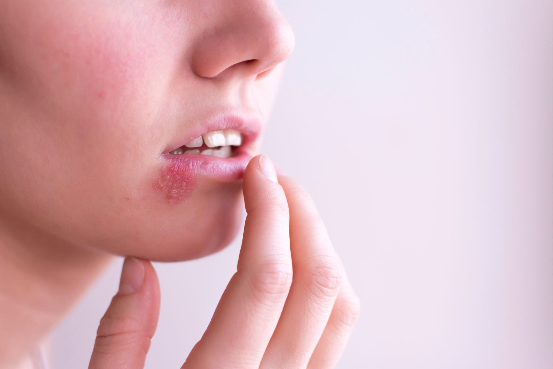 Apa itu Herpes Genital? Kenali Gejala, Penyebab dan Cara Mengobatinya